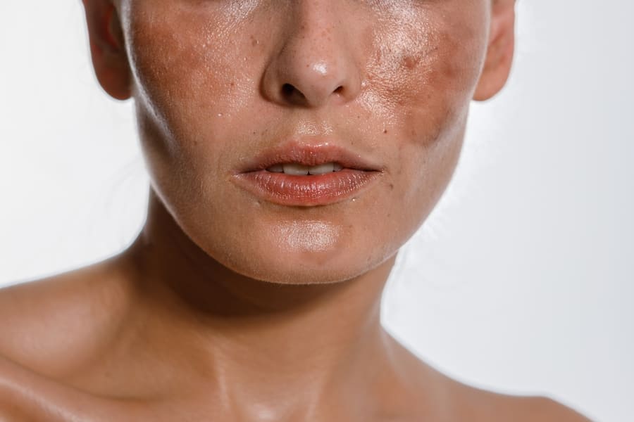 Melasma e Manchas