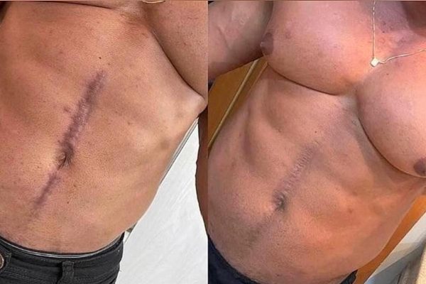 Abdomem