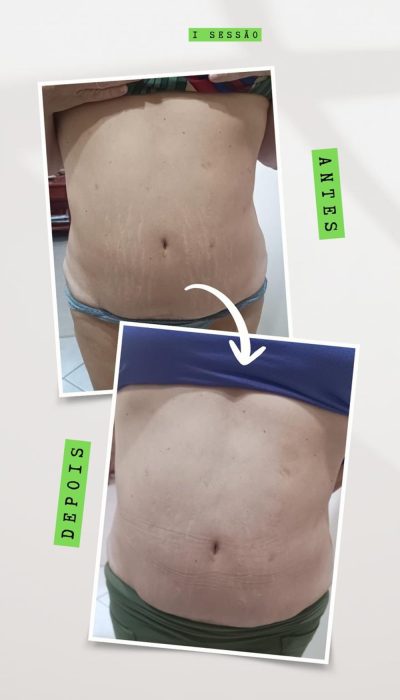 antes e depois